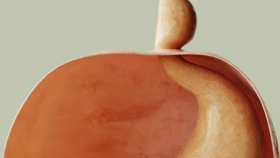 Axial hiatus hernia type 1 - entrance to the stomach via the diaphragm -- 3D rendering