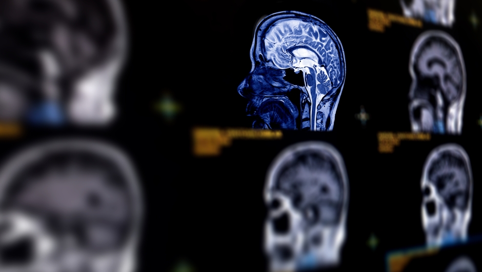 Selective focus of MRI brain sagittal plane for detect a variety of conditions of the brain such as cysts, tumors, bleeding, swelling, developmental and structural abnormalities or infections .