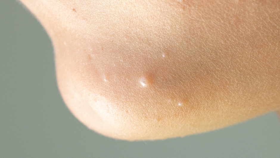 Close-up of Molluscum Contagiosum also called water wart. Viral formations in the chin on the skin of the child. Maternal plaque is in the center and small later rash around. Health care.
