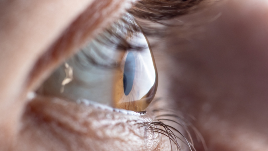Macro eye. Ophthalmic disease - keratoconus.