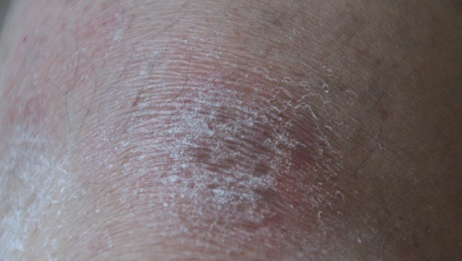 A photo of some damaged skin