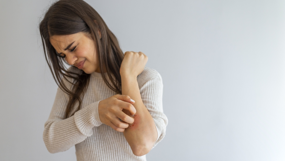 Eczema: i trattamenti che funzionano, secondo la scienza