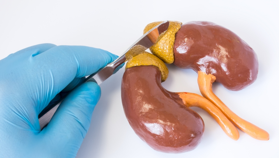 Adrenal gland surgery concept photo. 3D anatomical shape of adrenal gland and kidneys next to  surgeon hand in blue glove holding scalpel. Surgery operation in cancer, tumor, pheochromocytoma, adenoma