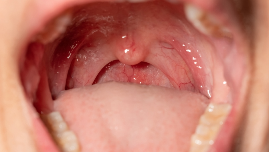 Sore throat with throat swollen. Closeup open mouth with posterior pharyngeal wall swelling and uvula and tonsil. Influenza follicles in the posterior pharyngeal wall. Macro shot of lymphoid follicles