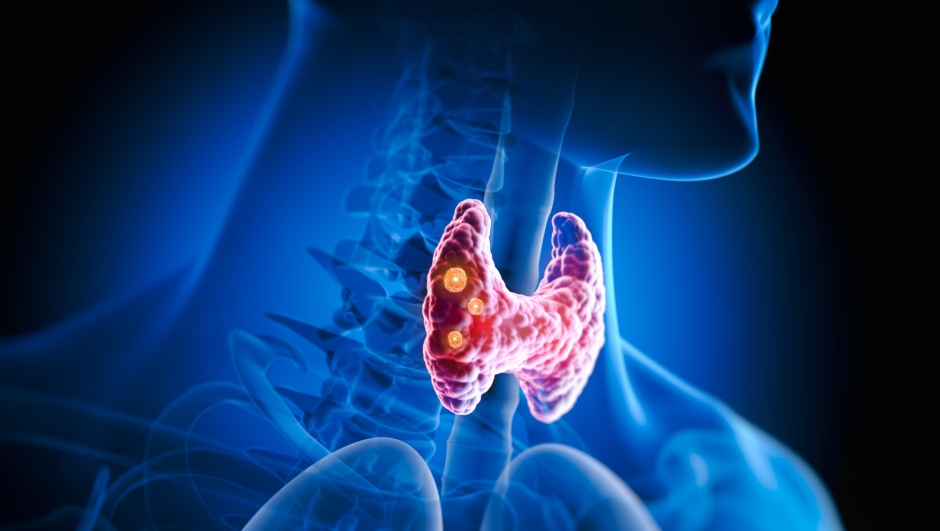 Thyroid gland with nodules inside human body - 3D illustration
