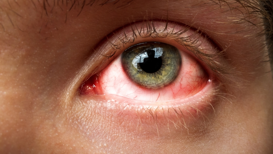conjunctivitis, conjunctival inflammation, red eyes, infection and inflammation, close up eye