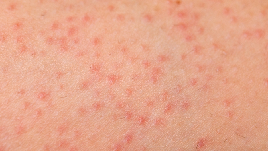 Close up picture of folliculitis problem on female skin