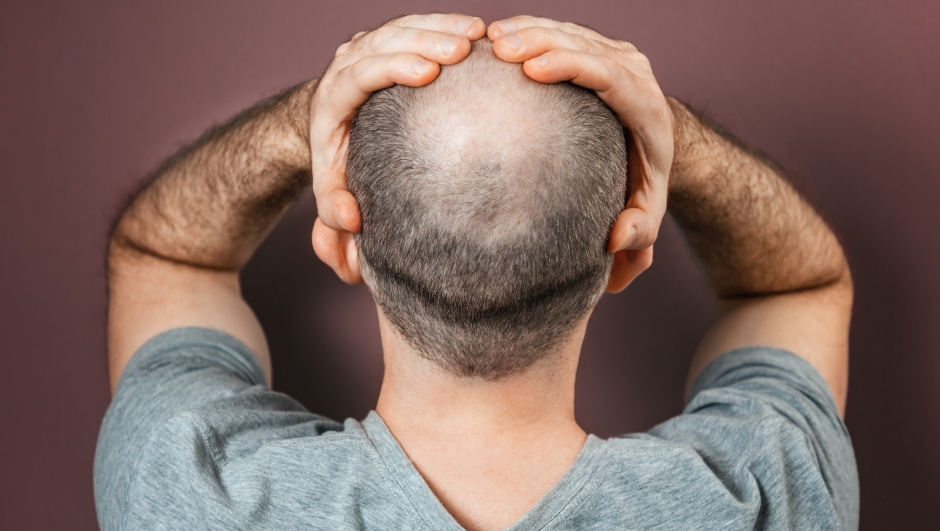 Alopecia: la soluzione (forse) si nasconde in dispensa