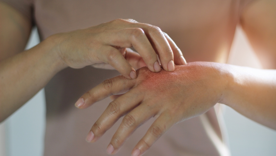 Bolle sulla pelle con o senza prurito: cause e rimedi