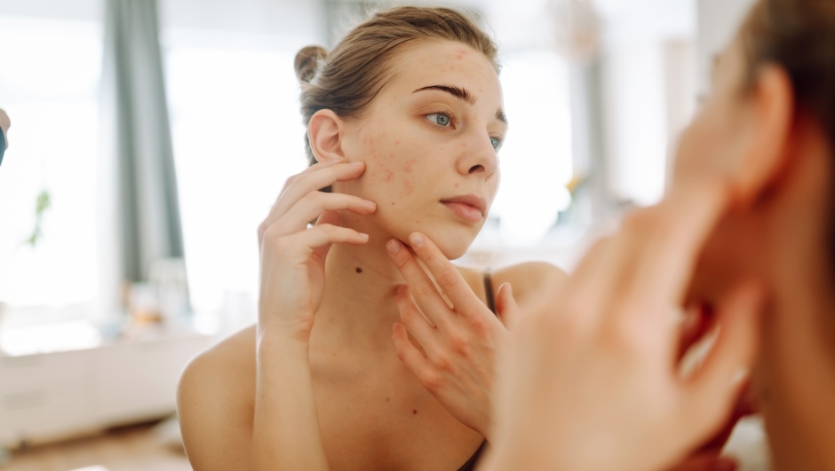 Contro l'acne gli Omega-3 sono grandi alleati: ecco perché