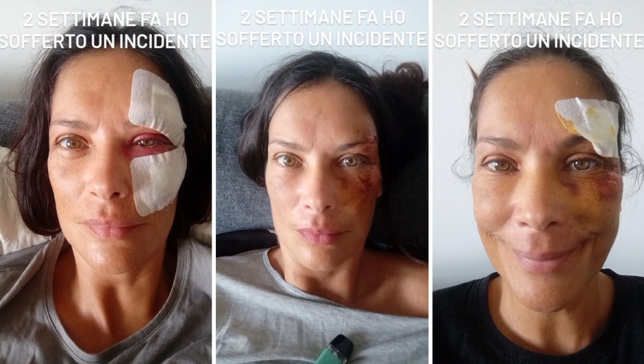 Fernanda Lessa, incidente durante una passeggiata coi cani