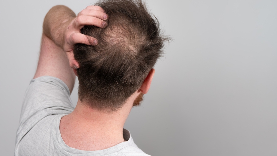 Caduta capelli carenze vitamine e minerali