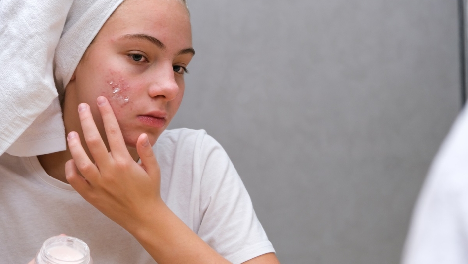 Crema anti-acne cancerogena