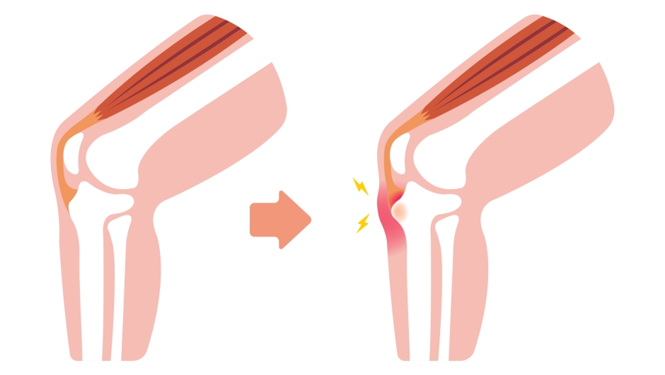 Morbo di Osgood-Schlatter