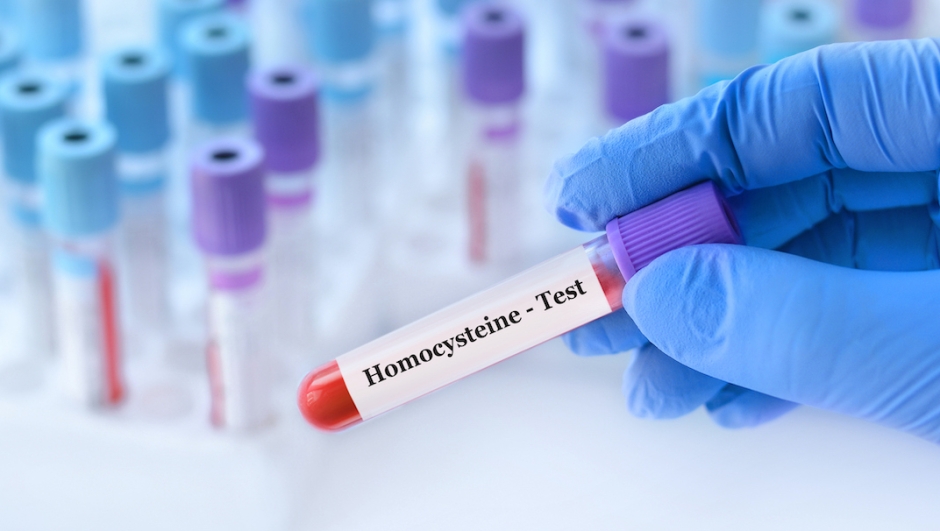 Doctor holding a test blood sample tube with homocysteine test on the background of medical test tubes with analyzes