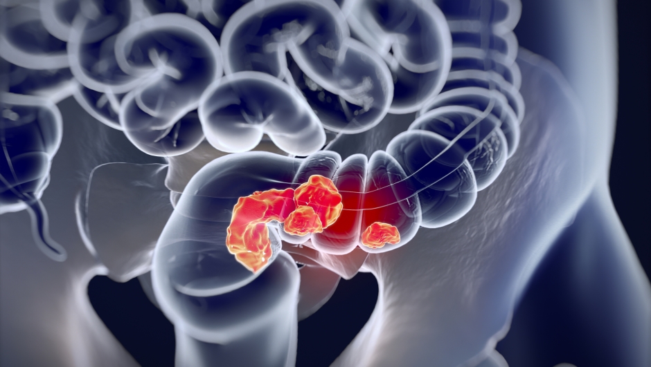 Colorectal cancer,medical anatomical illustration.3d illustration