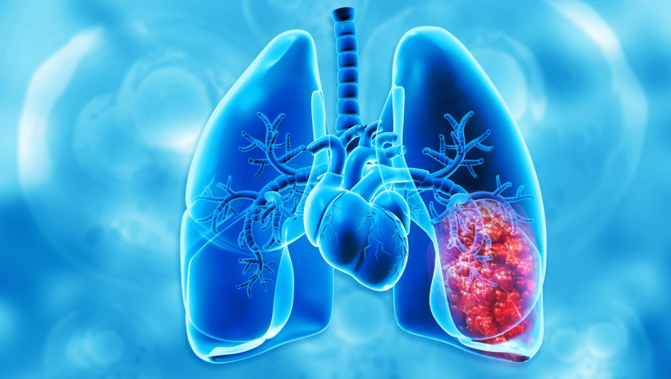 Il tumore al polmone può colpire anche i non fumatori? Ecco le cause e i sintomi