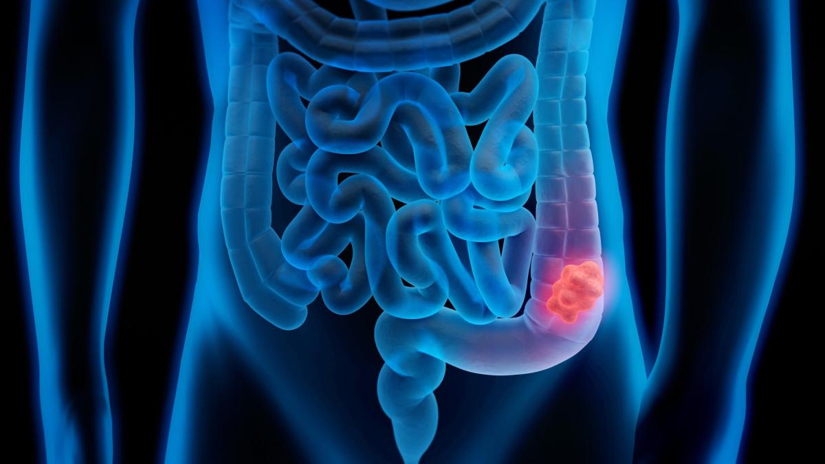 gli oncologi italiani tumore al colon retto precoce in allarmante aumento