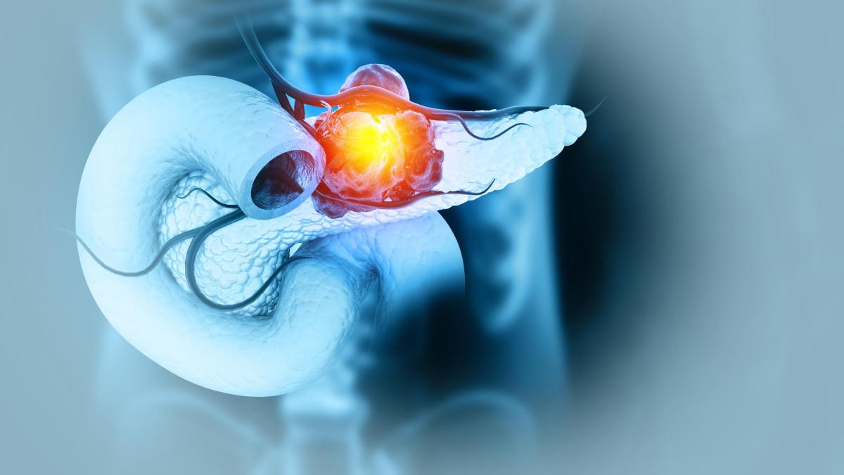 Tumore al pancreas, dai primi sintomi alle cure più innovative: cosa sapere