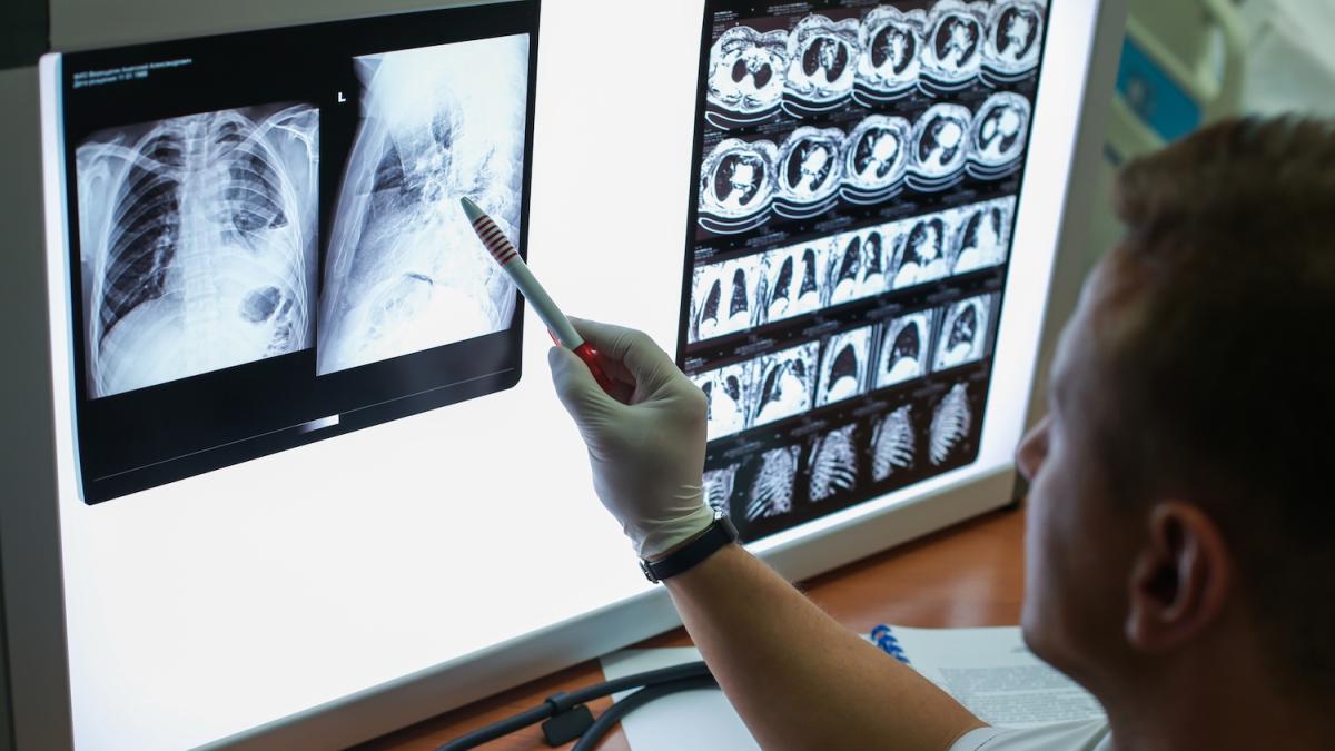 Tumore al polmone: arrivano i farmaci-scudo per prevenirlo