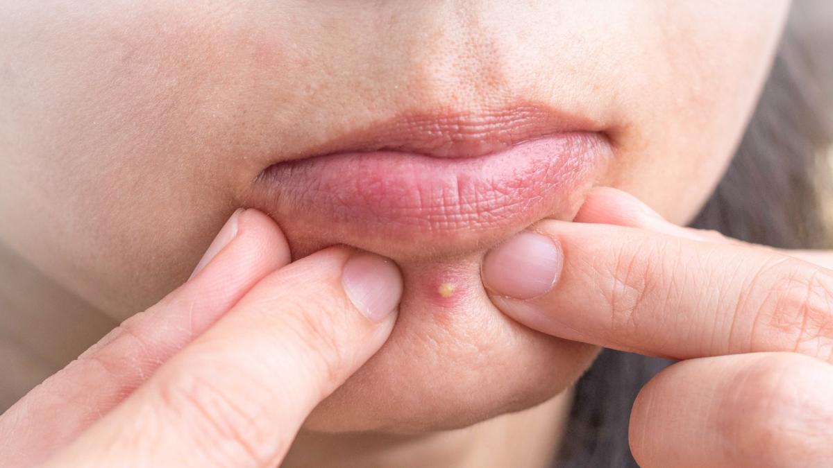 brufoli da alimentazione perch233 sono diversi dall acne e cosa mangiare per evitarli da Gazzetta.it brufoli da alimentazione perch233 sono diversi dall acne e cosa mangiare per evitarli