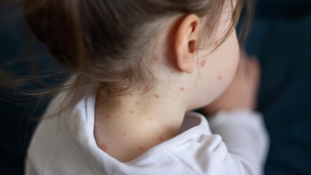 La Vitamina A riduce il rischio morbillo? La verità secondo gli scienziati