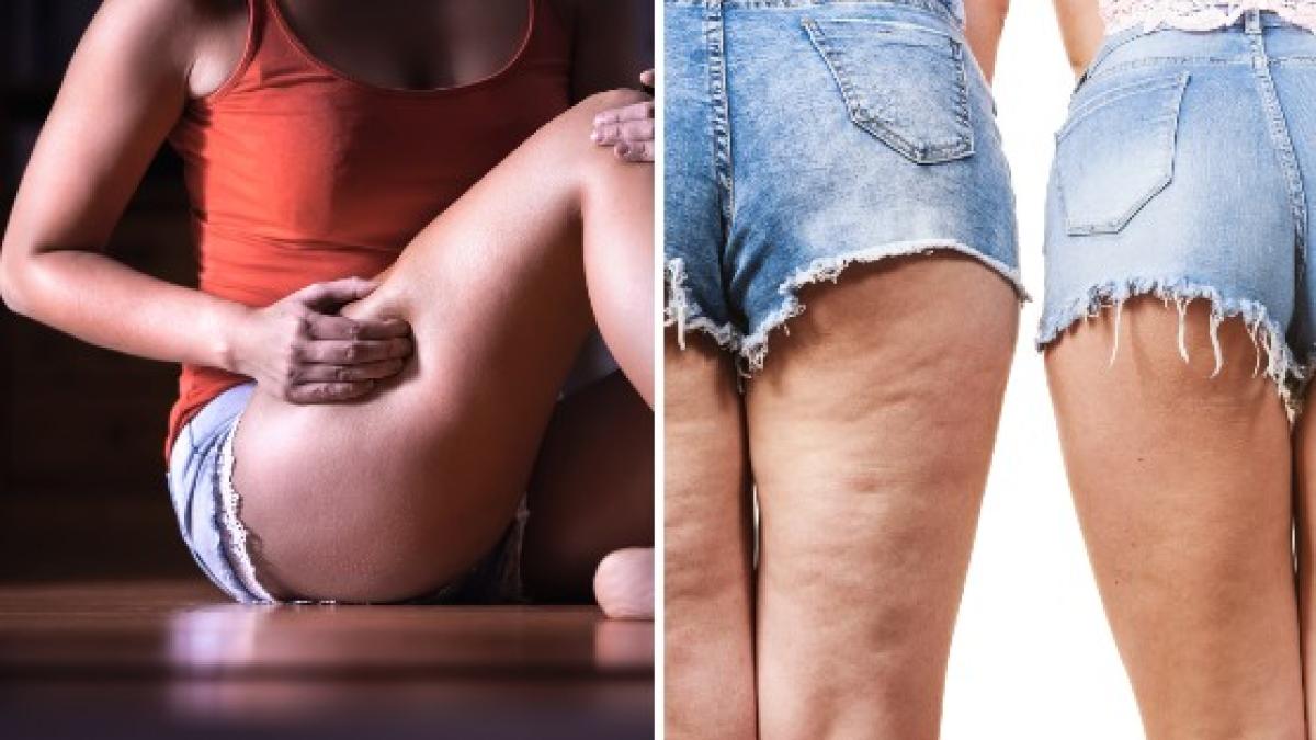 Diet for Water Retention: Foods to Include & Avoid