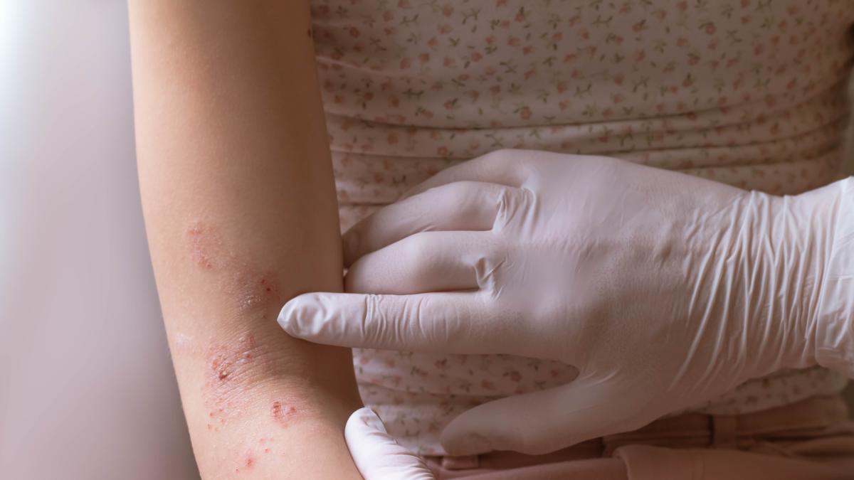 dermatofilosi o malattia della pioggia aumentano i casi in europa cos 232 e quali sono i sintomi da Gazzetta.it dermatofilosi o malattia della pioggia aumentano i casi in europa cos 232 e quali sono i sintomi