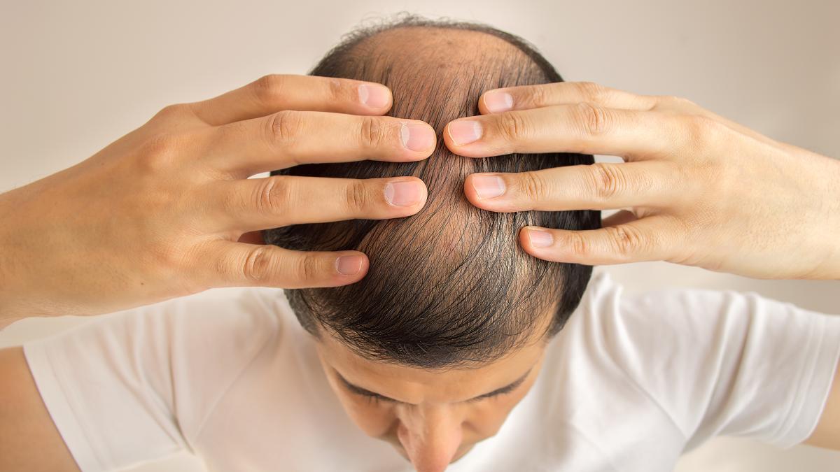 Caduta dei capelli: differenze tra uomini e donne, causa e possibili cure