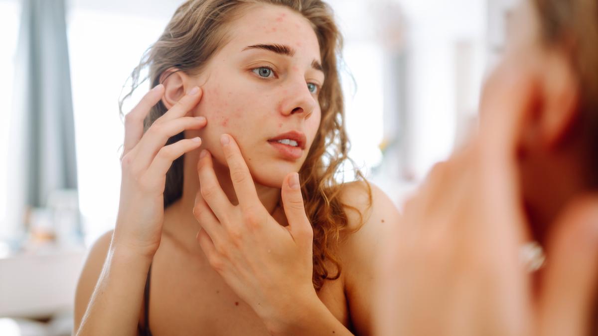 Brufoli e alimentazione: i cibi che peggiorano l’acne e quelli che migliorano la pelle Brufoli e alimentazione: i cibi che peggiorano l’acne e quelli che migliorano la pelle