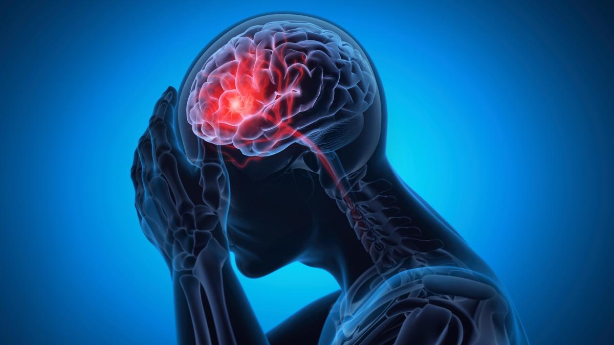 Rischio ictus e punteggio Car: come capire se ci sono placche nelle arterie