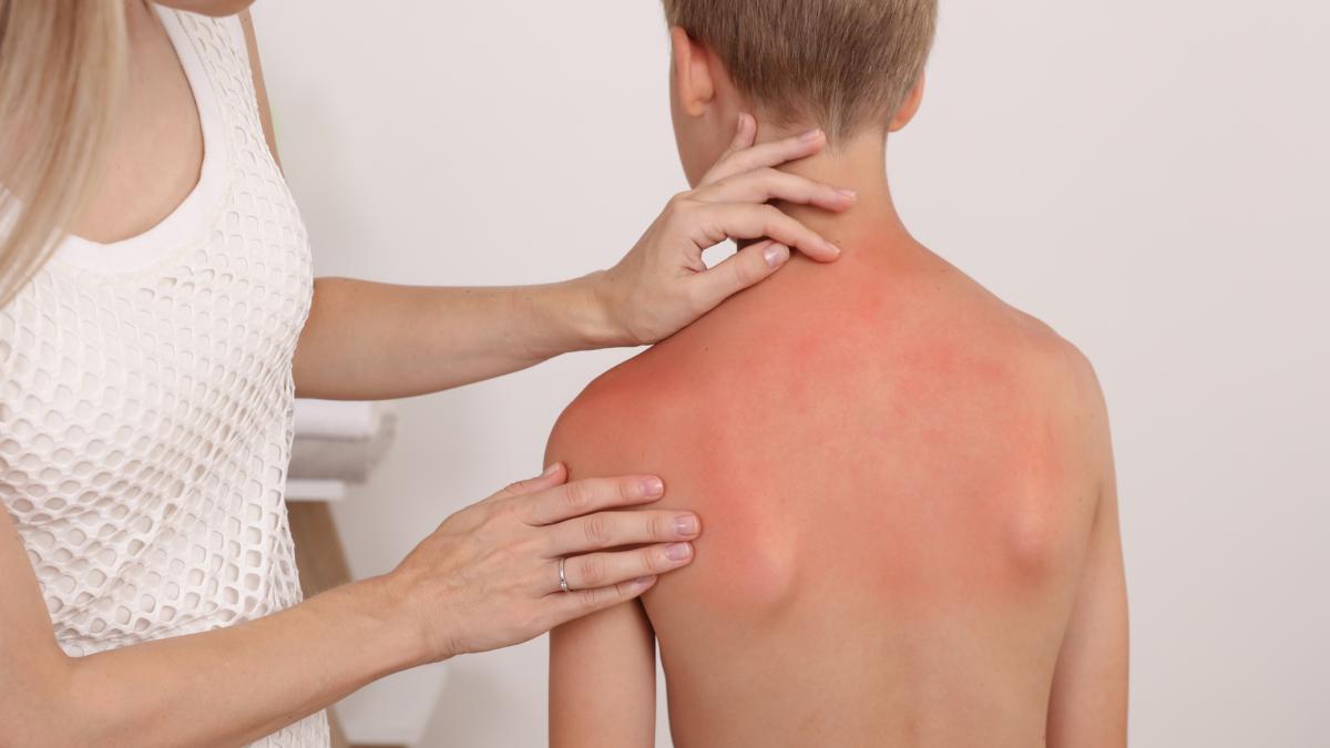 Melanoma: 80% di rischio in più per chi si è scottato da ragazzino Melanoma: 80% di rischio in più per chi si è scottato da ragazzino