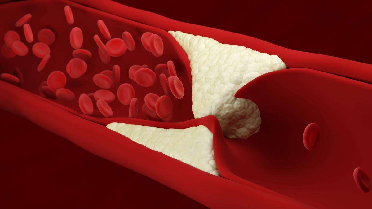 Quando il colesterolo alto è genetico: combattere l’ipercolesterolemia familiare con farmaci e dieta Quando il colesterolo alto è genetico: combattere l’ipercolesterolemia familiare con farmaci e dieta