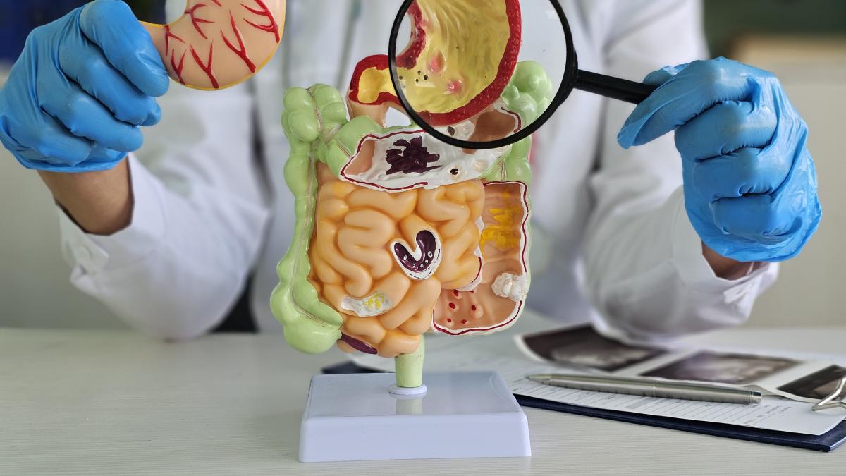Tumore al colon retto: l Tumore al colon retto: l