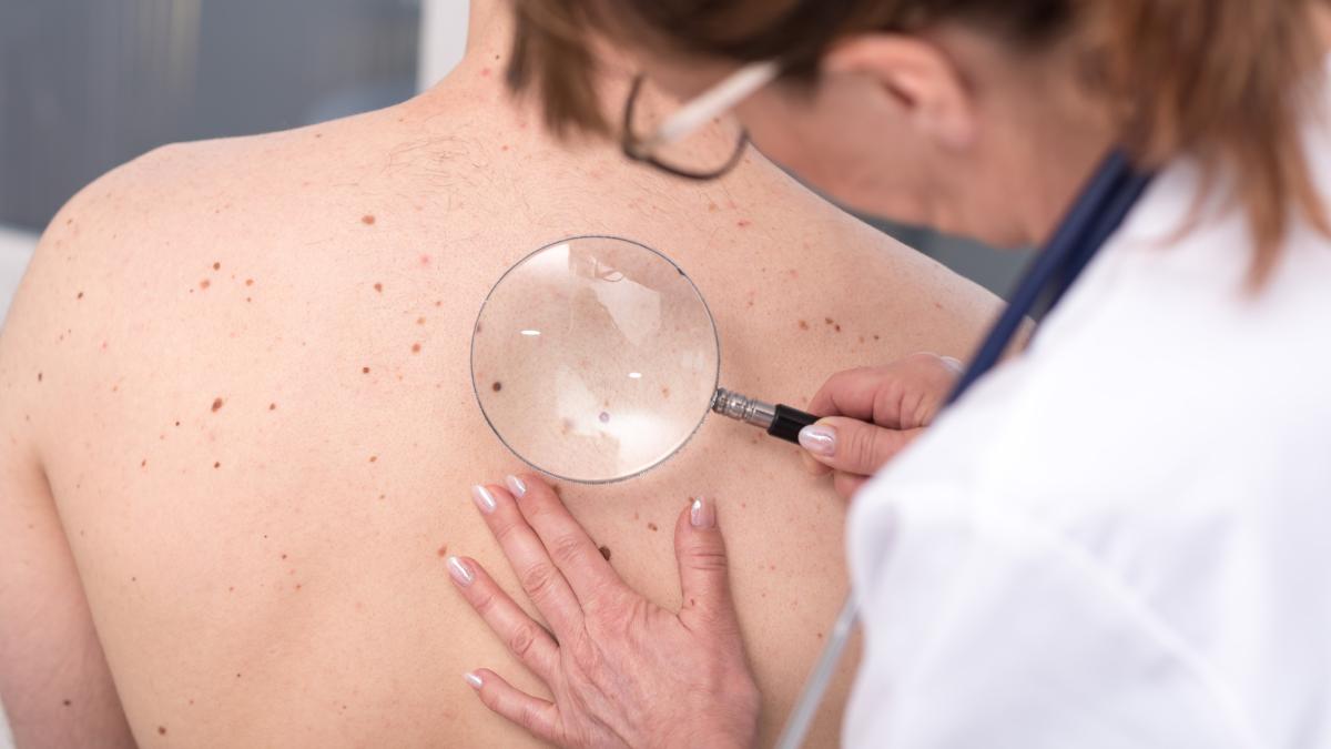 Macchie solari e tumori della pelle: come distinguerli e come si fa la diagnosi Macchie solari e tumori della pelle: come distinguerli e come si fa la diagnosi
