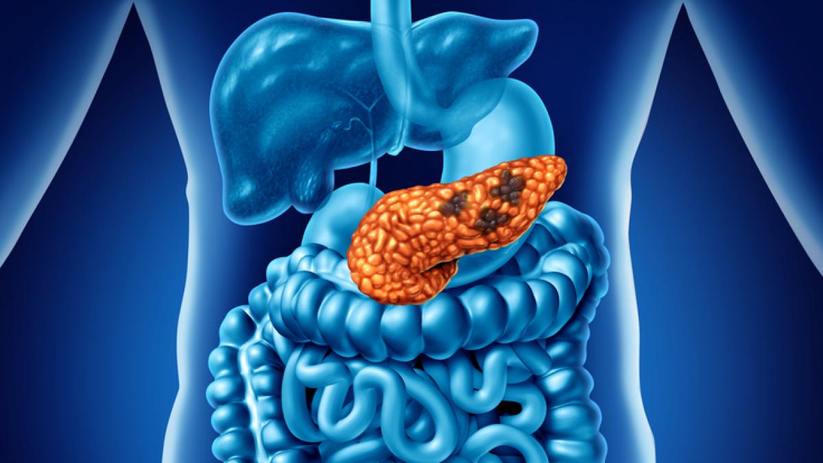 Tumore al pancreas: l Tumore al pancreas: l