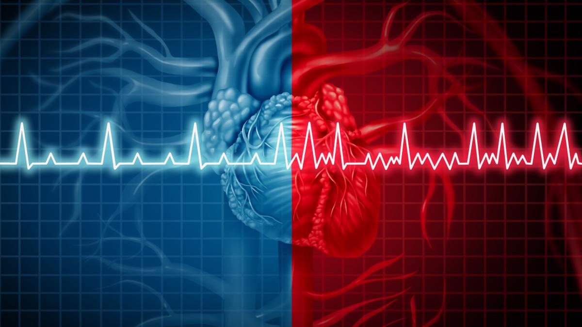 Aritmie cardiache: cosa sono, come si curano con l’ablazione e quali sono i pericoli Aritmie cardiache: cosa sono, come si curano con l’ablazione e quali sono i pericoli