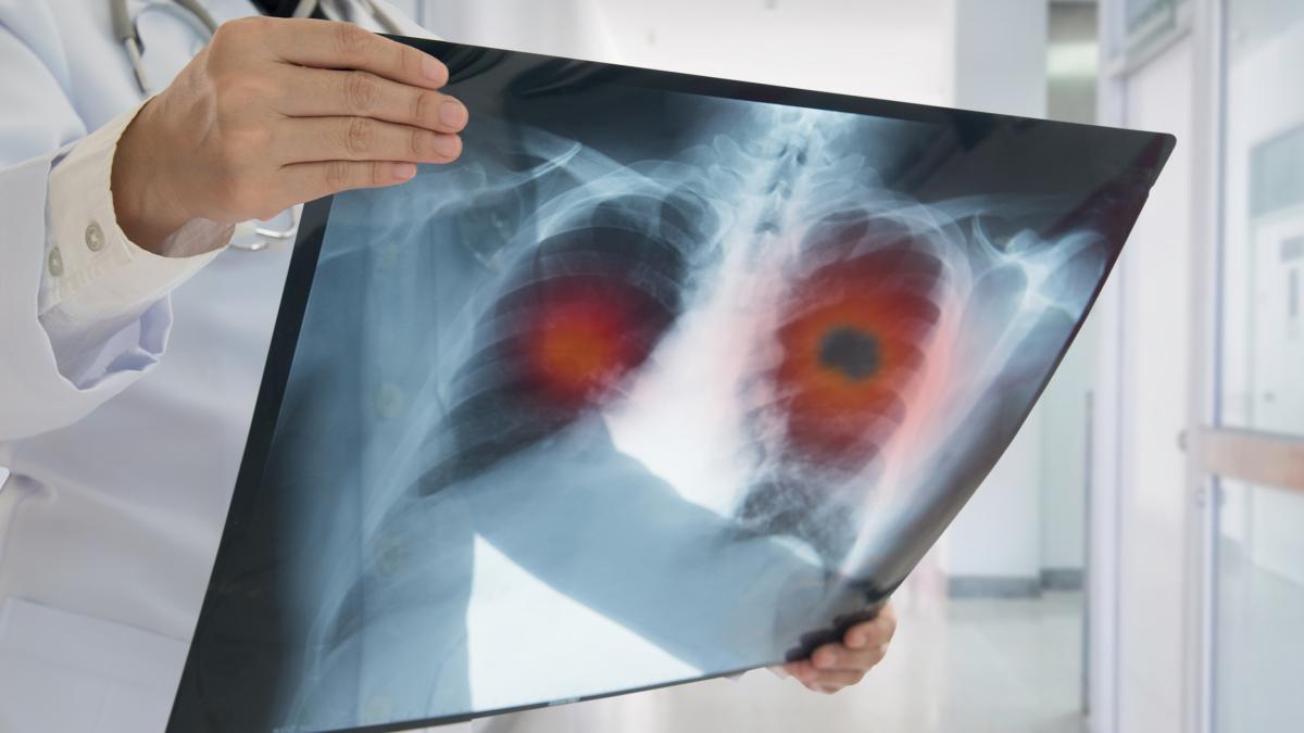 cancro ai polmoni in chi non ha mai fumato cosa fa aumentare il rischio di tumore