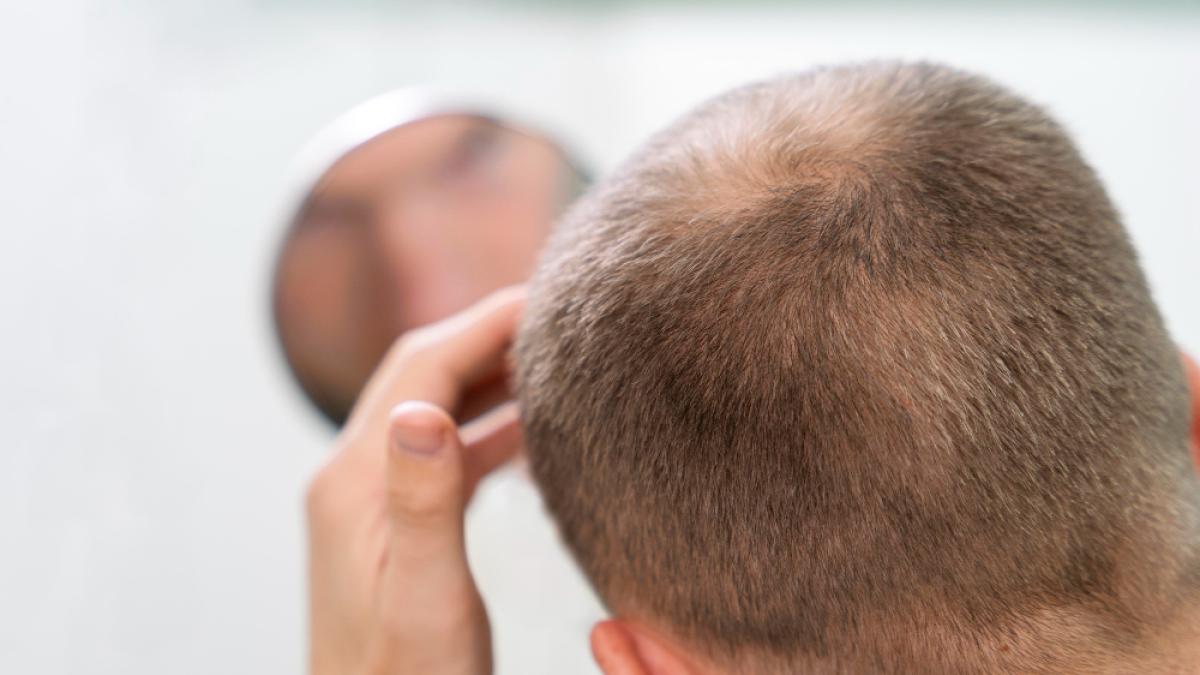 Un dolcificante contro la calvizie: dalla stevia un cerotto per far ricrescere i capelli
