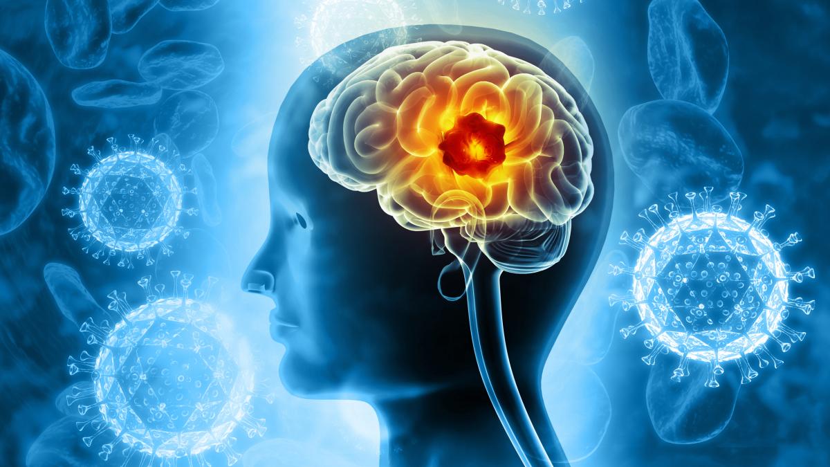 Tumore al cervello: nuove speranze da un cocktail di molecole