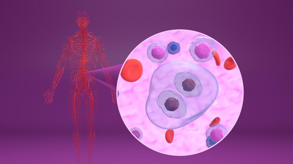 Linfoma di Hodgkin: cos’è e perché colpisce anche i giovani
