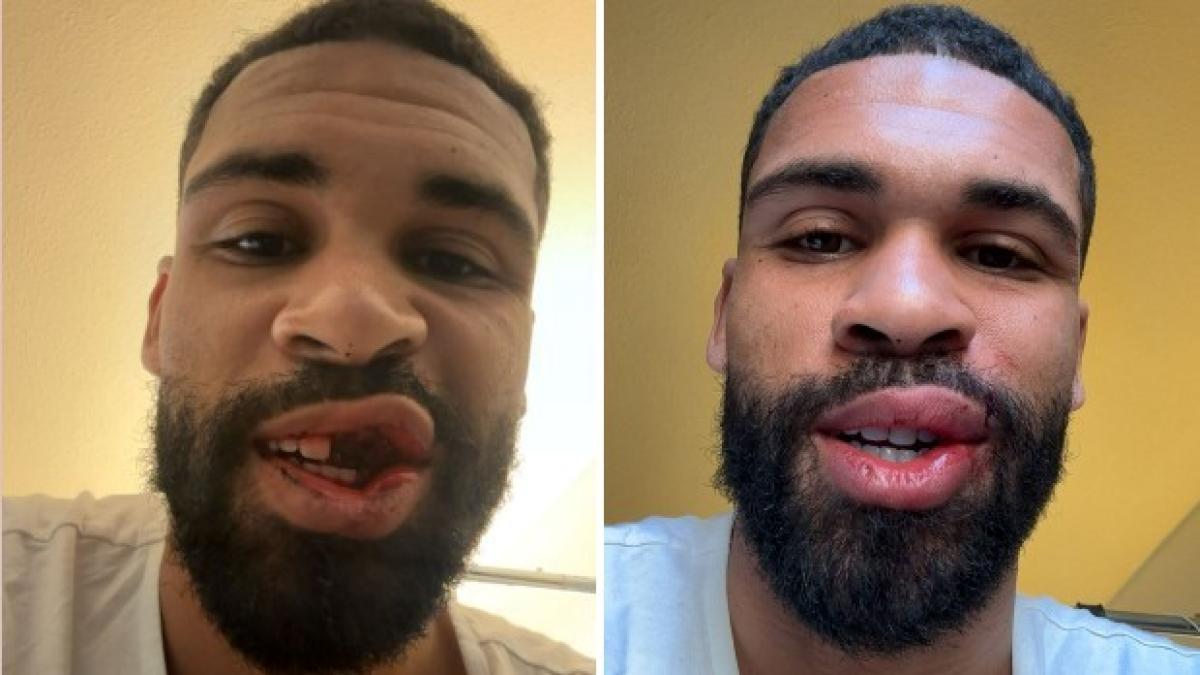 Loftus Cheek: foto impressionanti, ma operazione ai denti riuscita. Tornerà in campo tra due mesi