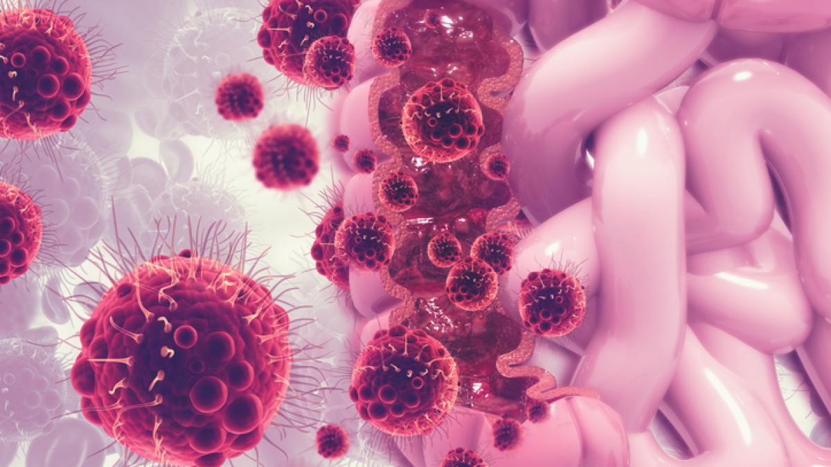 Cancro al colon-retto: quando e perché può essere causato da disbiosi intestinale