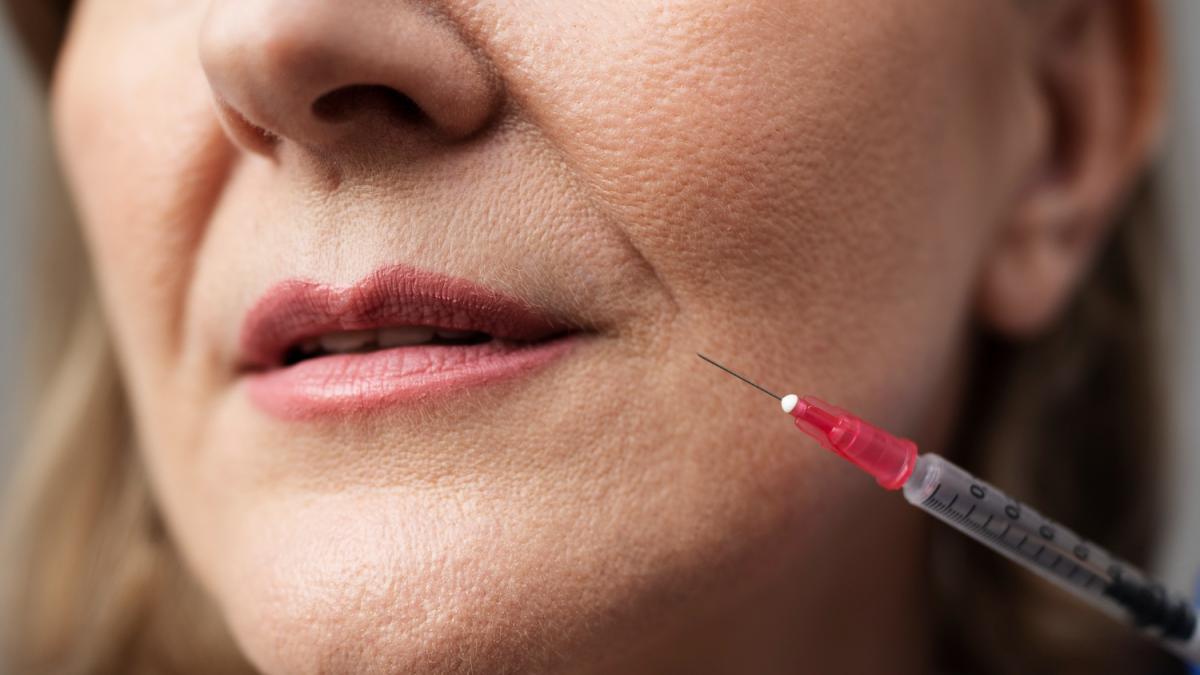 Filler permanenti: quando toglierli? Parla Daniel Cassuto, il chirurgo che li studia da 20 anni