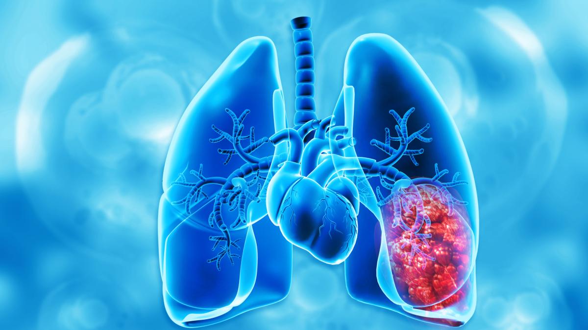Il tumore al polmone può colpire anche i non fumatori? Ecco le cause e i sintomi