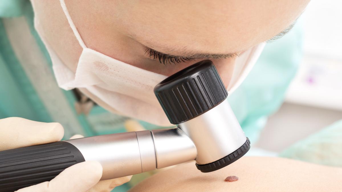 Melanoma: ecco come si può eliminare senza intervento chirurgico