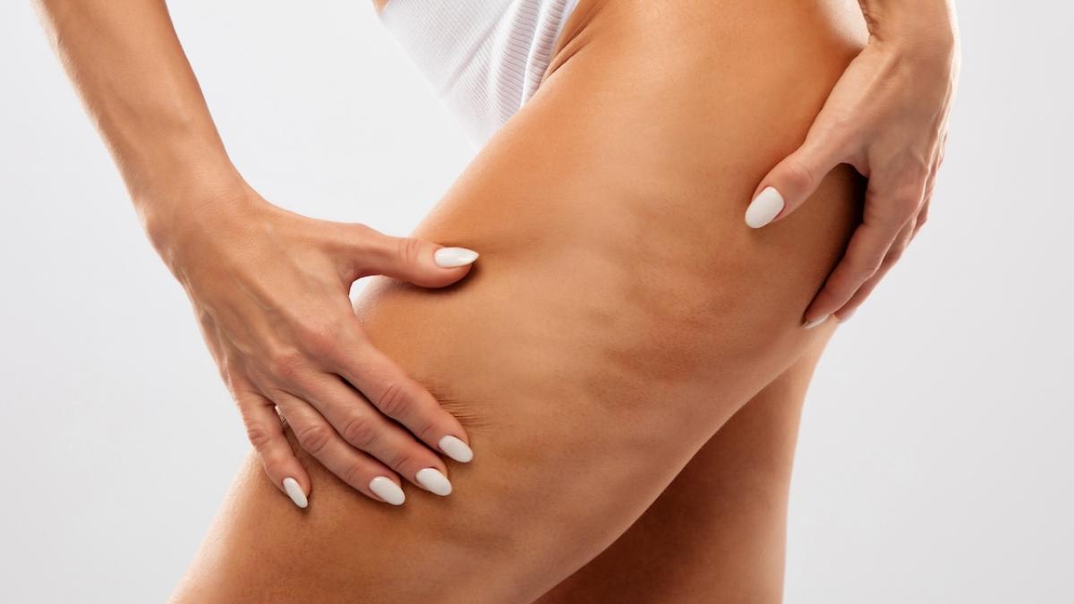 Integratori anticellulite: ecco quali sono i migliori rimedi naturali e davvero efficaci