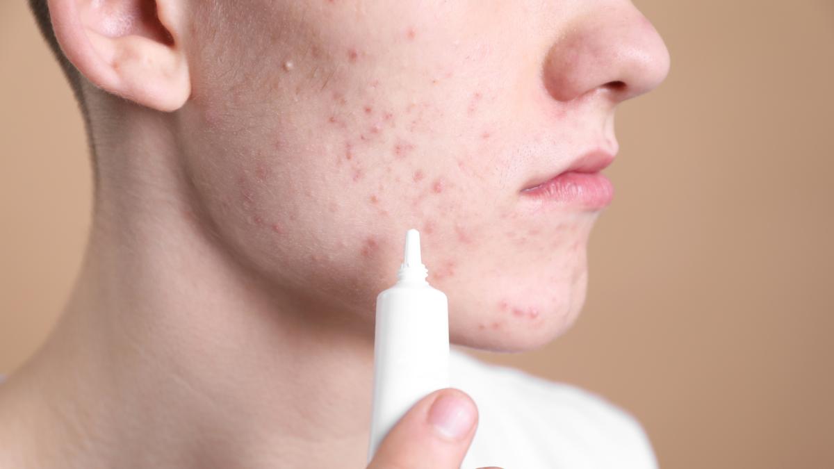 acne quanto incide l8217alimentazione e quali cibi aiutano a ridurla da Gazzetta.it acne quanto incide l8217alimentazione e quali cibi aiutano a ridurla