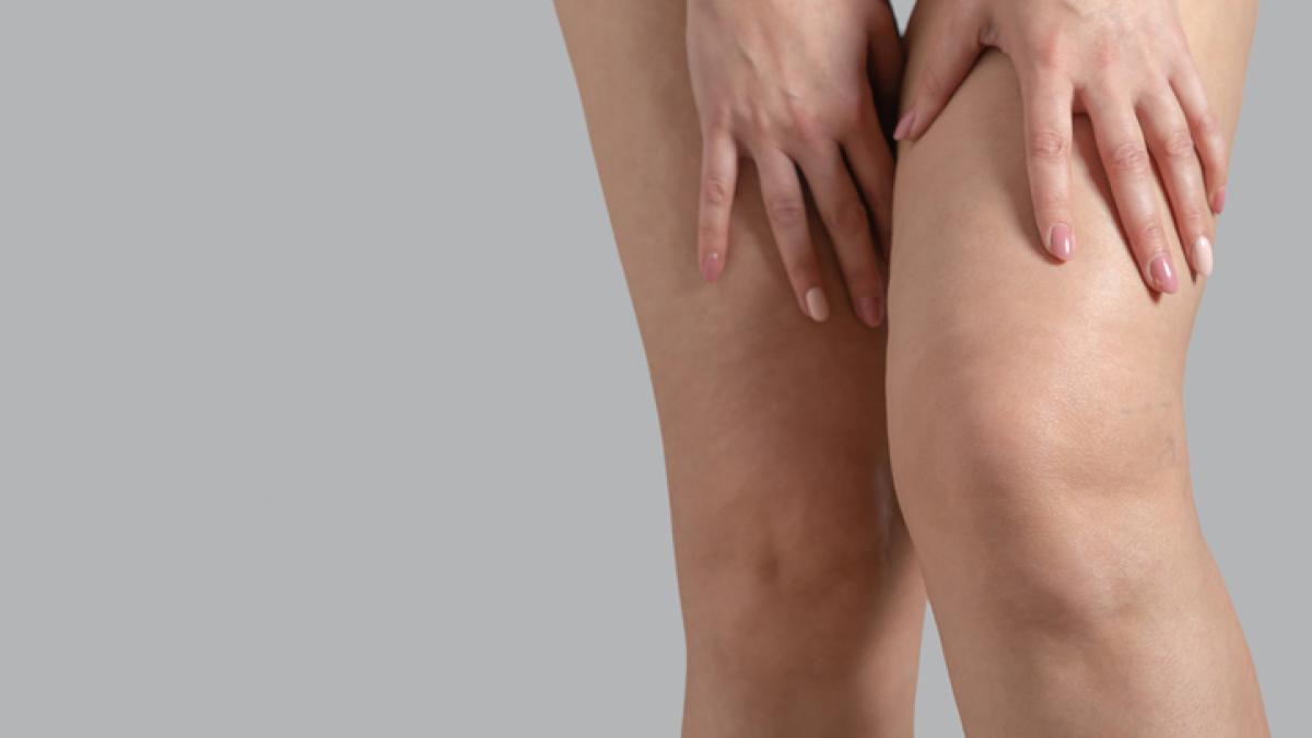 Le differenze tra linfedema e lipedema e come riconoscerle