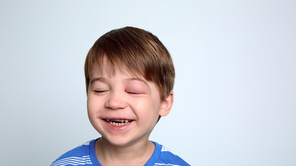 Angioedema ereditario: come non confonderlo con un'allergia